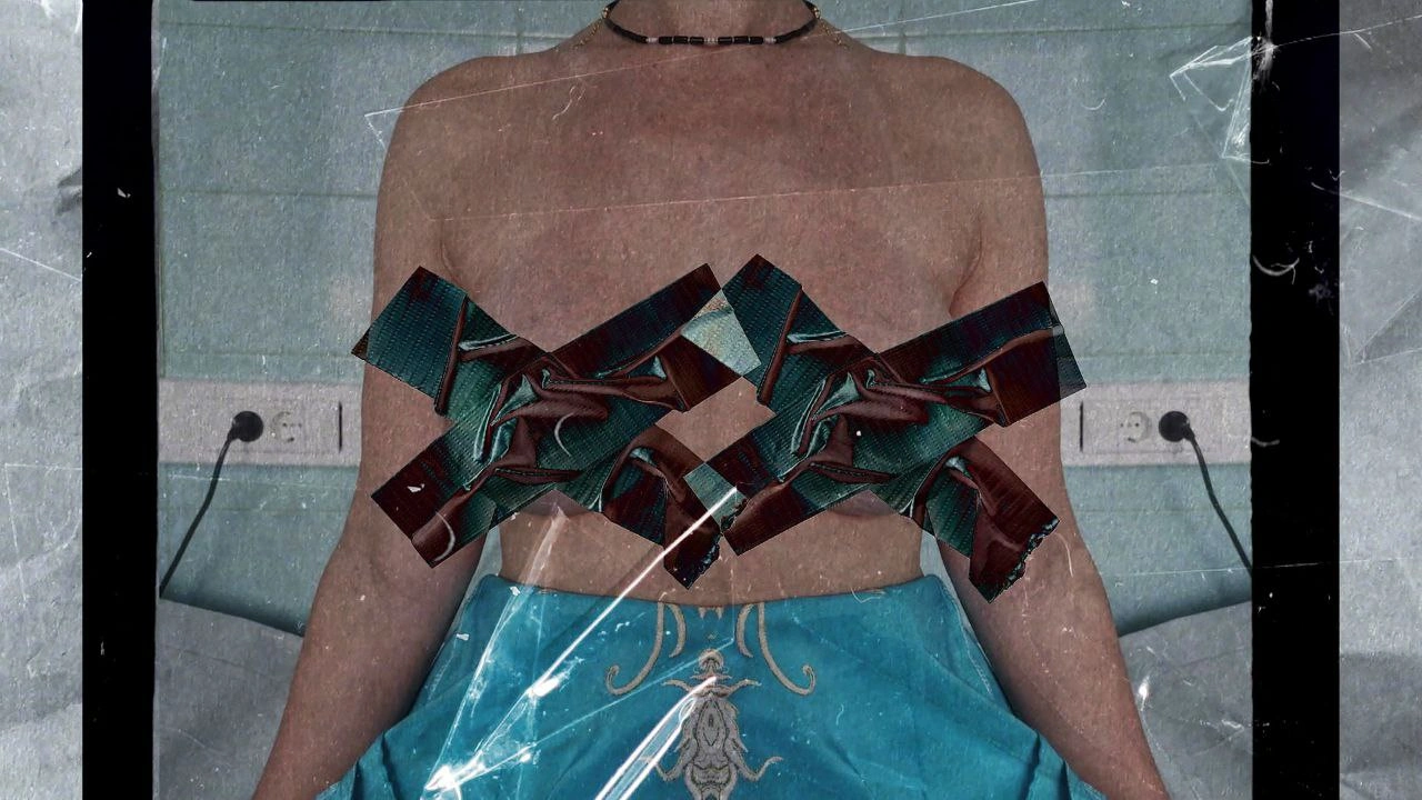 Капсулярная контрактура